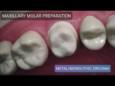 Dr VK's Dental Skool | MAXILLARY MOLAR | TOOTH PREPARATION | ALL METAL AND MONOLITHIC ZIRCONIA