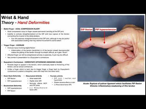 Hand Deformities ✋ How to Identify Them (for NPTE ⭐)