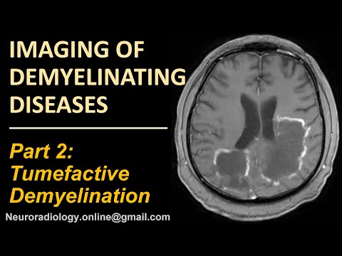 Imaging of Tumefactive Demyelination.