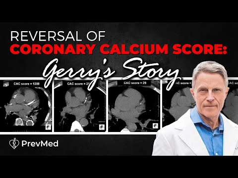 Reversal of Coronary Calcium Score: Gerry's Story