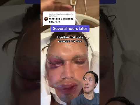 What Happened to His Face? #facelift