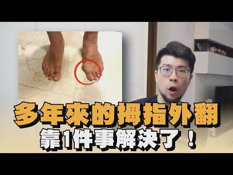 多年來的拇指外翻　靠1件事解決了！｜#全民話燒