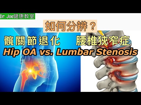如何分辨髖關節退化還是腰椎狹窄呢？［Eng Subtitles]  The Difference Between Hip Osteoarthritis vs. Lumbar Stenosis?