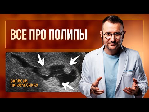 Все про ПОЛИПЫ МАТКИ. Как удалять полипы  | Гинеколог Дмитрий Лубнин