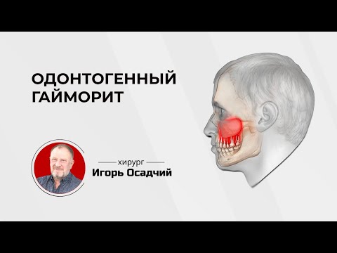 Одонтогенный или стоматологический гайморит