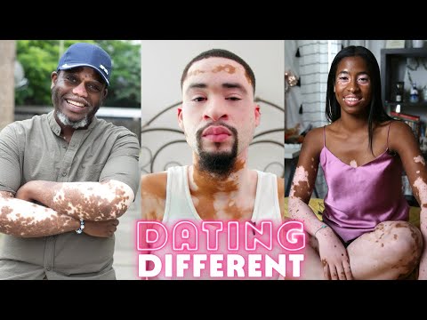 Trying To Find Love With Vitiligo | DATING DIFFERENT