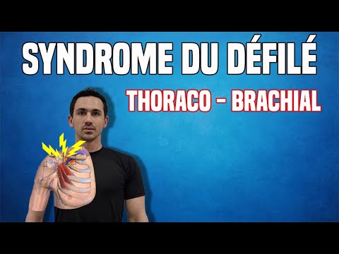 SYNDROME DU DÉFILÉ THORACO-BRACHIAL : EXERCICES DE RÉÉDUCATION (KINÉ)