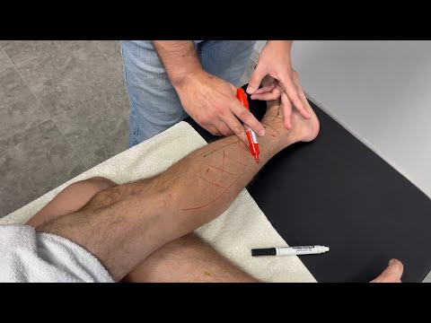 How to get rid of leg pain. Shin pain. The answer is in this video!