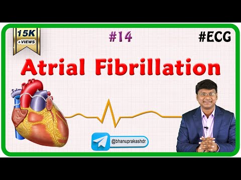 14. Atrial fibrillation  - ECG assessment and ECG interpretation made easy