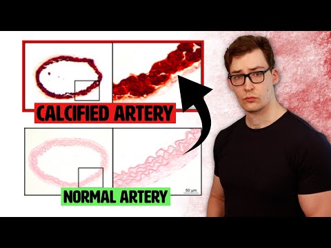 This Mineral Deficiency is causing Calcified Arteries.