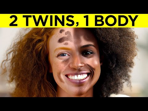 Twins Who Are One in a Million