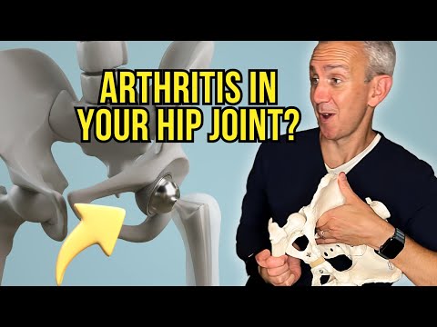 Hip Osteoarthritis & Pain Explained: What Really Works? Top Treatments
