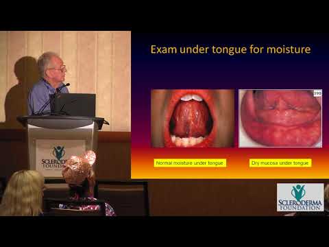 Dry Eyes, Dry Mouth (Sicca Syndrome versus Sjogren’s Syndrome) Philip Clements, MD, MPH- 2017