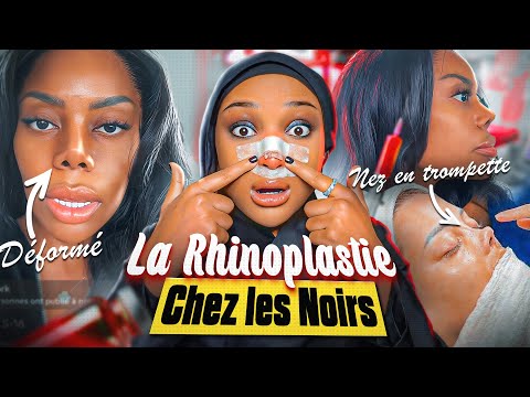 Les NOIRS et les NEZ REFAIT : ÉCHEC ou RÉUSSITE 