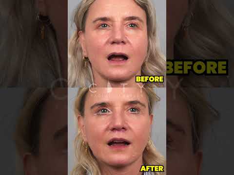 INCREDIBLE Elelyft Lip Lift Result