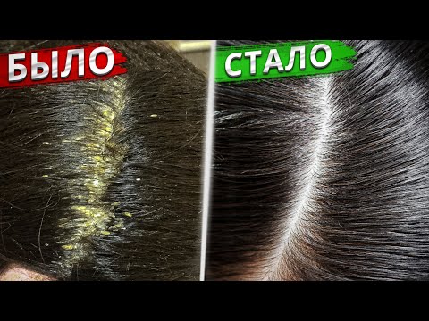 DANDRUFF: TOP 5 mistakes and treatment methods WITHOUT medication