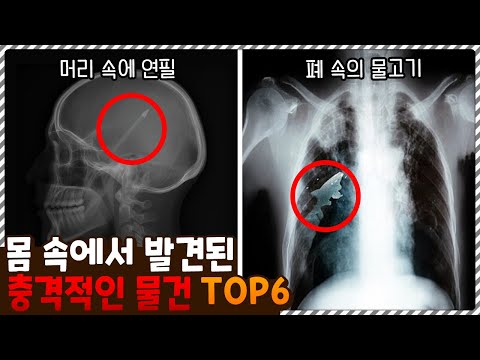 어쩌다가 들어간거지..? 몸 속에서 발견된 충격적인 물건들 TOP6