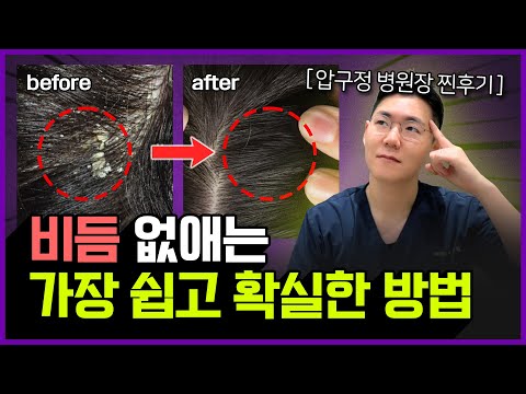 "이걸 모르면 비듬 생깁니다..." | 비듬 없애는법, 비듬 1도 없는 두피 만드는 비법
