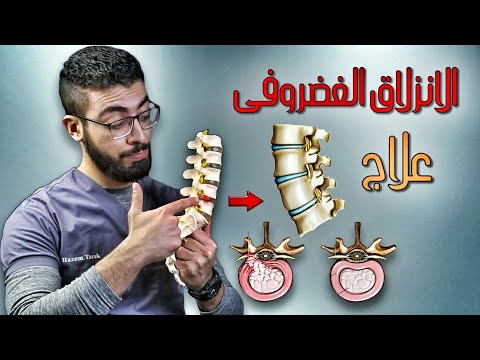 دكتور حازم يوضح أهم أسباب الاصابة بالانزلاق الغضروفي | 3 تمارين لعلاج الديسك - ألم أسفل الظهر