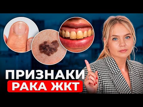 Эти симптомы рака ЖКТ 90% пациентов ИГНОРИРУЮТ!