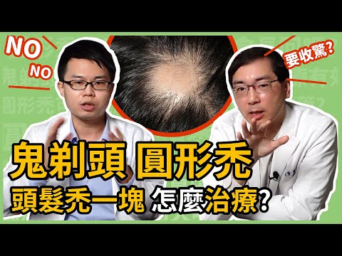 為什麼會有圓形禿？鬼剃頭是因為壓力大嗎？楊省三醫師與林政賢醫師來告訴你圓禿應該怎麼治療！