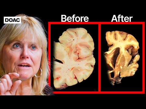 THE SILENCED DOCTOR: THIS Is The Fastest Way To Get Dementia… |  Brain Doctor, Dr. Ann Mckee