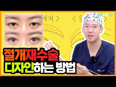 절개재수술 디자인하는 방법