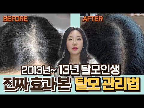 의사도 모르는 여자 정수리 탈모 극복 후기, 직접 해본 것들 중 효과본 것들만 풉니다.