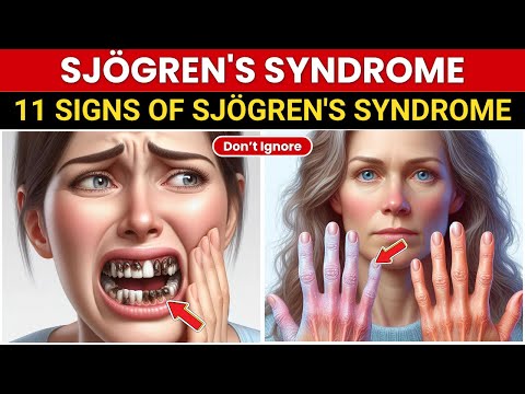 WARNING: 11 Sjögren's Symptoms You CANNOT Miss (Act Now!)