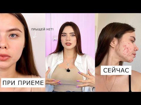 МНЕ НЕ ПОМОГ РОАККУТАН 😭