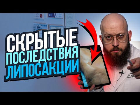 ВСЕ МОЛЧАТ ОБ ЭТИХ ПОСЛЕДСТВИЯХ ЛИПОСАКЦИИ. Какие бывают осложнения после липосакции