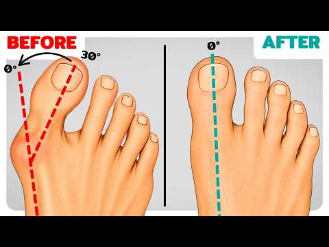 99% of People STILL Don’t Know the Basics of Fixing Bunions