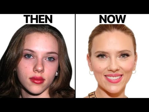 Scarlett Johansson's NEW FACE | Plastic Surgery Analysis