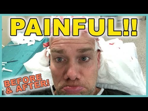 ** PAINFUL! ** Istanbul Hair Transplant 3 Month Results & "Day of" Documentary! (Before & After)