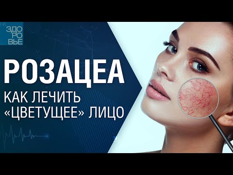 Розацеа. Как лечить «цветущее» лицо. На здоровье 28.12.2024