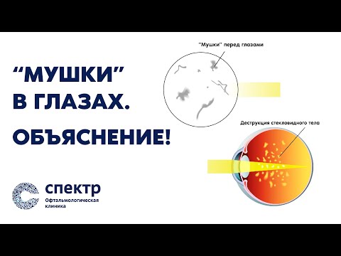 "Мушки в глазах". ОБЪЯСНЕНИЕ! Реально ли избавиться? Отвечает профессор, врач-офтальмолог Кожухов.