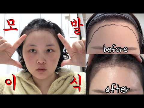 27년 고민 모발이식으로 드뎌 해결,,, 수술당일부터 2주차까지 리얼 후기 탈탈털기