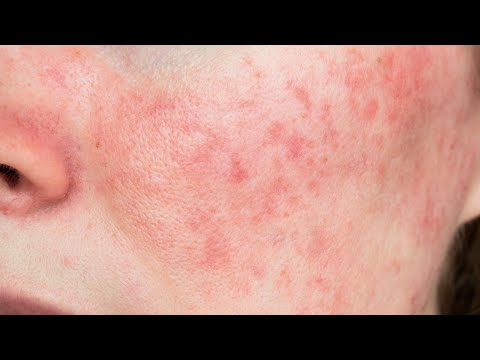 РОЗАЦЕА прямой эфир в записи: лечение (описание⬇️)