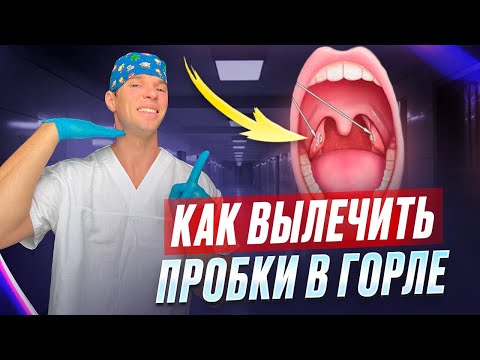 Белые пробки в гландах. Хронический тонзиллит. Миндалины. Как их лечить.