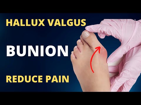 Bunions (Hallux Valgus) Treatment at Home Without Surgery