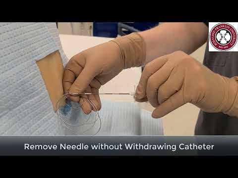 Placement of Epidural