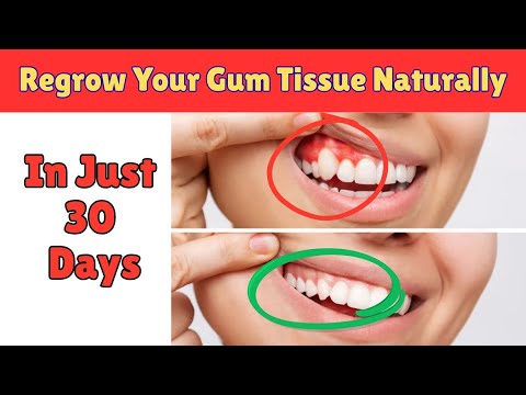 Regrow Your Gum Tissue Naturally | No Surgery Required | Medical Miracle