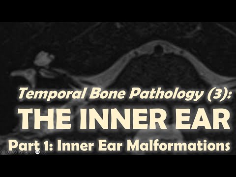 Temporal Bone Imaging (3): Inner Ear Malformations.