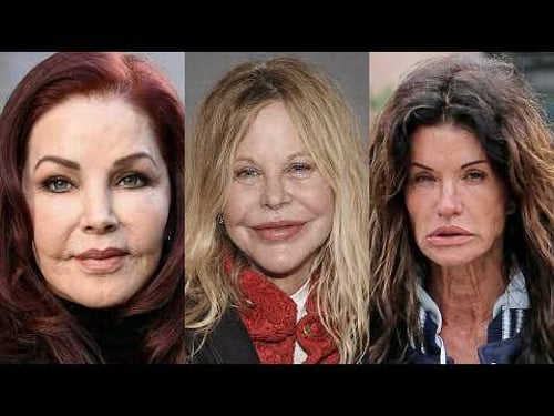 15 Classic Beauties Suffering From Pillow Face | Before and After Photos