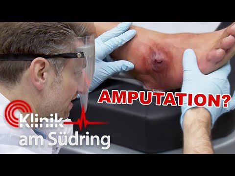 „Das sieht NICHT gut aus!“ Muss der Fuß amputiert werden? | Klinik am Südring | SAT.1
