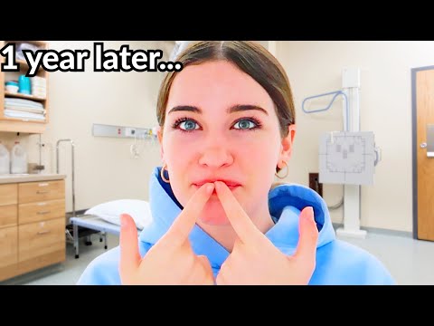 FIRST DAY WITHOUT BRACES (Honest Reaction) ft. Naz & The Norris Nuts