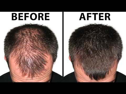 Everything You NEED To Know About Finasteride & Minoxidil