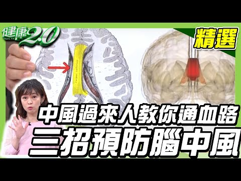 中風過來人教你通血路!三招全方位預防腦中風【健康2.0精選】