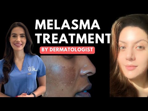Dermatologist approved routine for Melasma | How to use hydroquinone