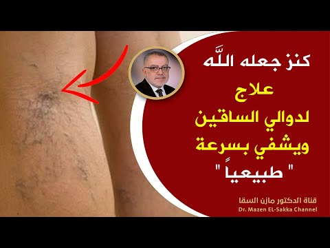 كنز جعله الله علاج دوالي الساقين ويشفي بسرعة طرق طبيعية لمحاربة الأوردة العنكبوتية ودوالي الساقين